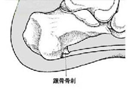 足跟骨刺的治疗方法介绍 治疗足跟骨刺的偏方
