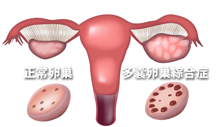多囊卵巢综合症能怀孕吗?多囊卵巢综合症的治疗方法