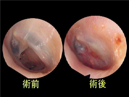 耳膜穿孔了会不会聋?耳膜穿孔怎么办?