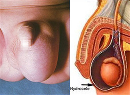 睾丸鞘膜积液的病因 睾丸鞘膜积液的治疗方法