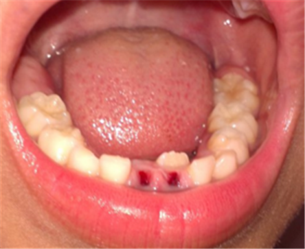 乳牙滞留的病因有哪些?乳牙滞留怎么办?