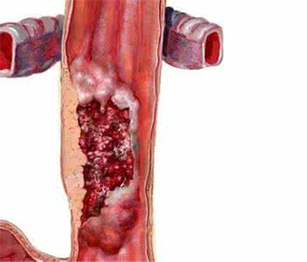 慢性食管炎是怎样引起的?慢性食管炎怎么治疗?