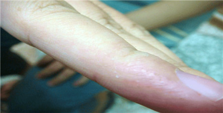 汗疹是怎么引起的?汗疹会传染吗?