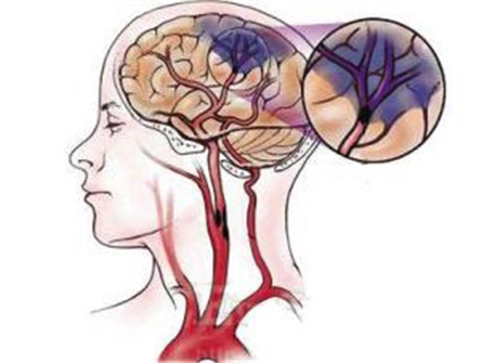 脑血管硬化的症状 脑血管硬化吃什么好?