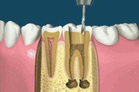 牙齿根管治疗术怎么做?牙齿根管治疗多少钱?