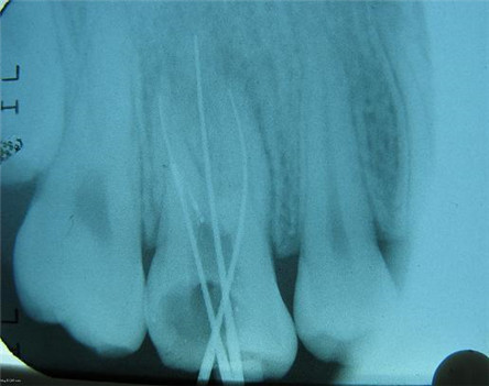 牙齿根管治疗术怎么做?牙齿根管治疗多少钱?