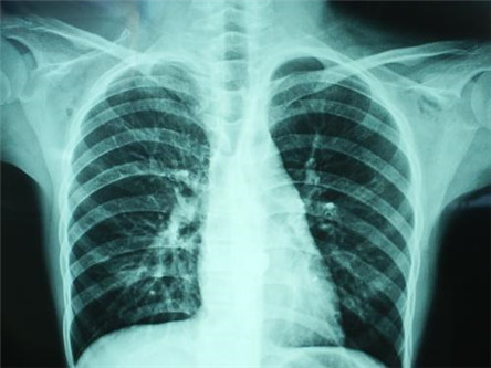 肺炎支原体感染的原因 肺炎支原体感染的治疗方法