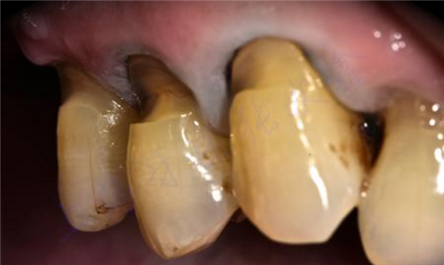 牙齿楔状缺损临床表现 牙齿楔状缺损护理