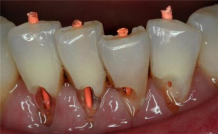 牙齿楔状缺损临床表现 牙齿楔状缺损护理