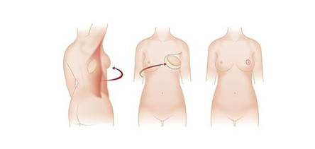 乳房再造的方法 乳房再造术什么时候做比较好?