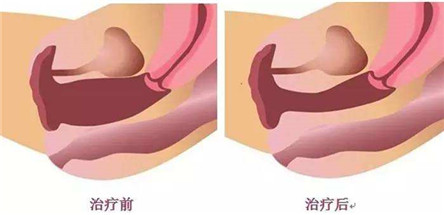 产后阴道松弛的危害 产后阴道松弛怎么办?