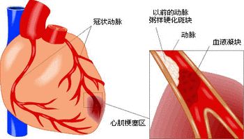 急性冠心症治疗 活性涂药心脏支架心肌梗塞率低