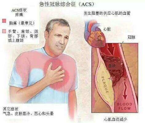 急性冠心症治疗 活性涂药心脏支架心肌梗塞率低