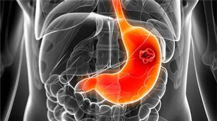 浅表萎缩性胃炎治疗方法 小心癌症找上你