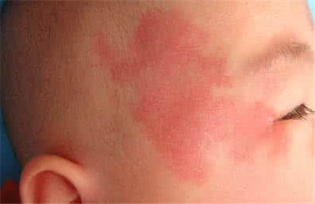 鲜红斑痣的初期症状 不要跟胎痣混淆了