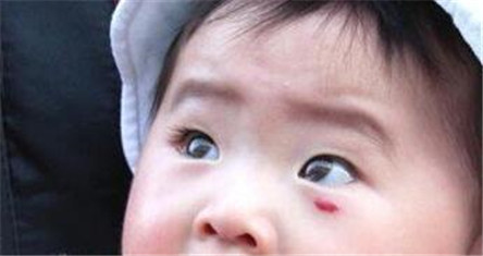 鲜红斑痣的初期症状 不要跟胎痣混淆了