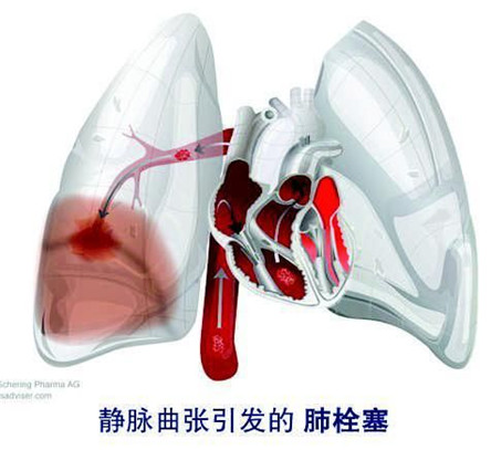 肺栓塞临床表现 忽然停止的呼吸
