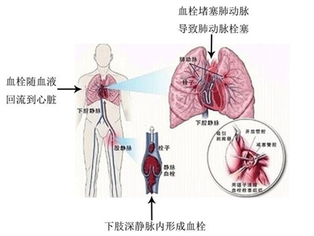 肺栓塞临床表现 忽然停止的呼吸