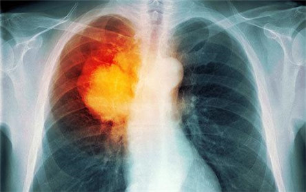 肺癌晚期能活多久?起决定性的3大因素