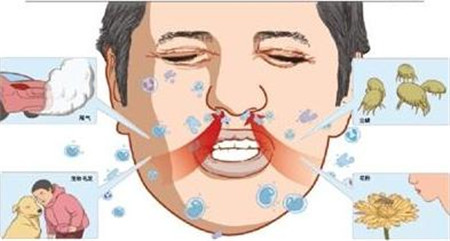 过敏性鼻炎的自我疗法大全 如何有效的预防反复发作