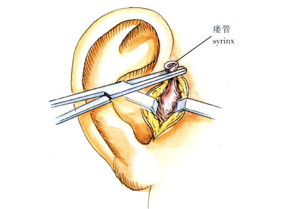 先天性耳前瘘管感染怎么办?手术才是最好的解决办法