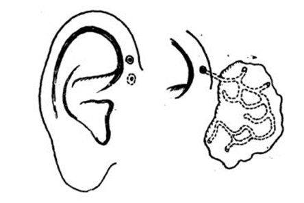 先天性耳前瘘管感染怎么办?手术才是最好的解决办法