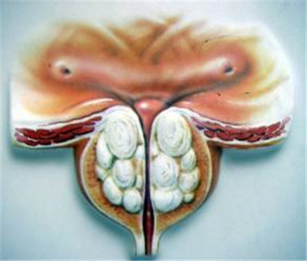 盘点前列腺结石治疗方法 别让结石影响到性生活
