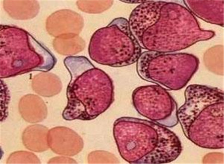 慢性淋巴细胞白血病危害和治疗方法