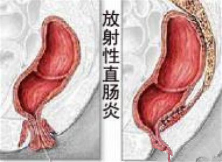 放射性直肠炎 小心有癌变的可能