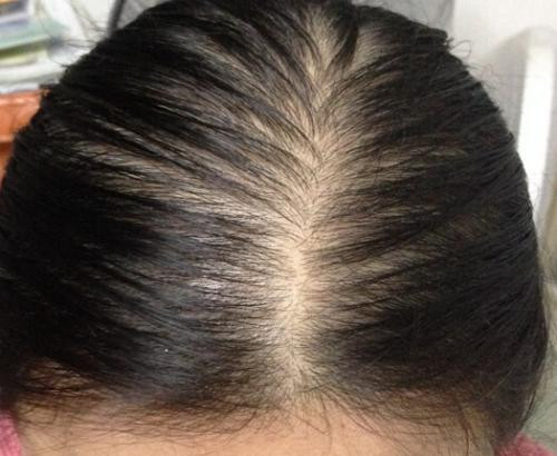 防止脱发的九种好方法 帮你远离秃顶的危机