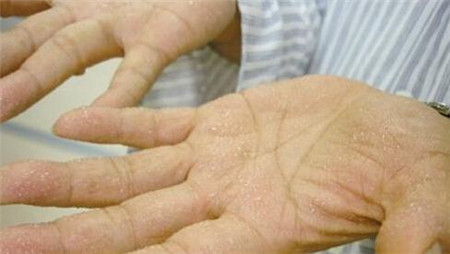 手脚出汗是什么原因?是身体的疾病预警?