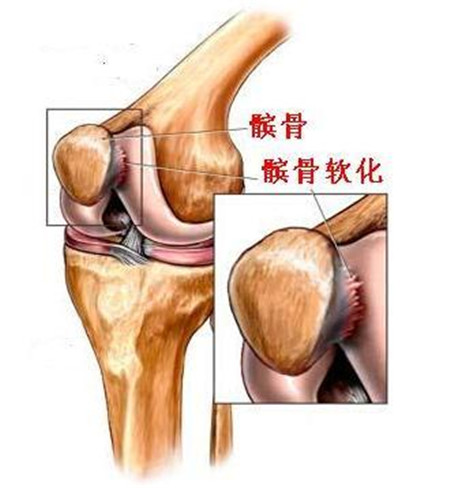 膝盖响可不是缺钙 而是一种髌骨软骨软化症