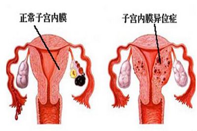 如何预防子宫内膜异位?先避免8大坏习惯