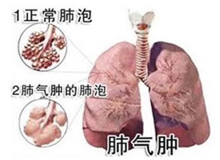 肺气肿的症状有哪些?该注意些什么?