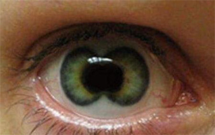 双瞳孔是怎样的?看东西会影响吗?