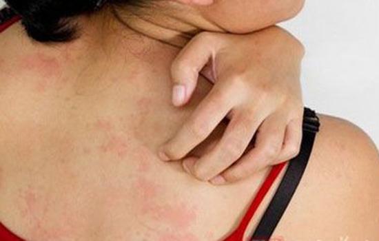 皮肤瘙痒症的常见症状是什么？