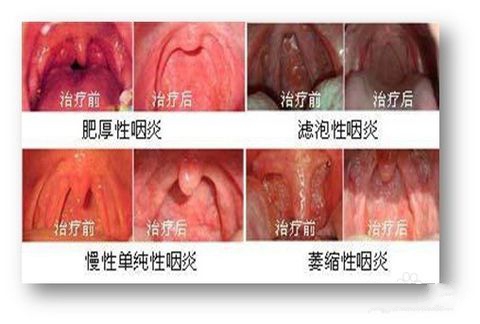 慢性单纯性咽炎的症状是什么？