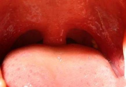 、慢性肥厚性咽炎的症状是什么？