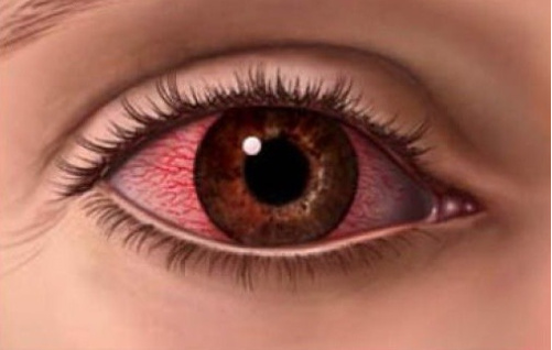 眼睛充血的原因是什么？