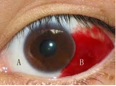  如何预防眼球充血？